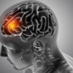 Waspada 5 Jenis Disabilitas yang tersebut mana Sering Dialami Pasien Stroke