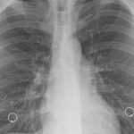 6 Kasus Pneumonia Mycoplasma Ada di dalam pada RI, Kemenkes Tidak Tutup Kemungkin Adanya Pandemi Baru